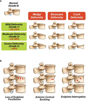 Bone health in childhood and adolescence: an overview on dual-energy X-ray absorptiometry scanning, fracture surveillance and bisphosphonate therapy for low-middle-income countries